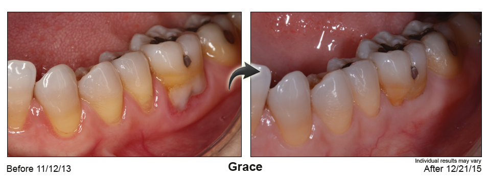 fix gum recession El Cajon