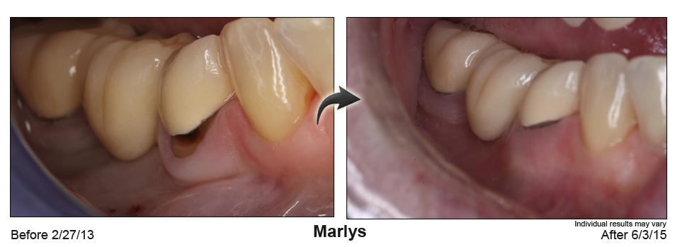 fix receding gums El Cajon